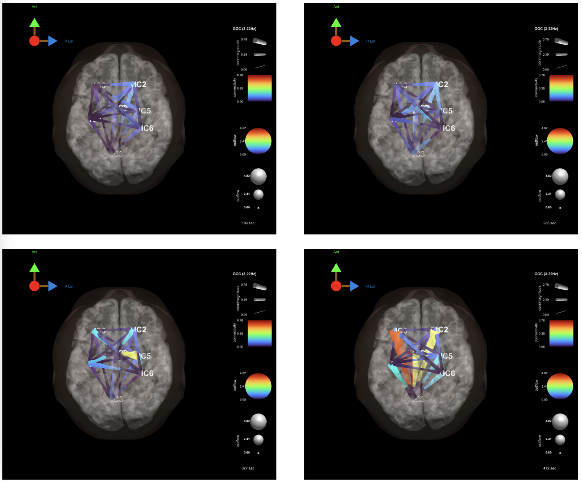 Four panels showing brain activity maps with colored connectivity lines between regions labeled IC2, IC3, IC5, and IC6, with color scales indicating connectivity strength and output. A small 3D sphere and pill icons are also present.
