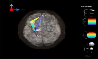 Brain scan with labeled regions and color-coded indicators for different areas of the brain.