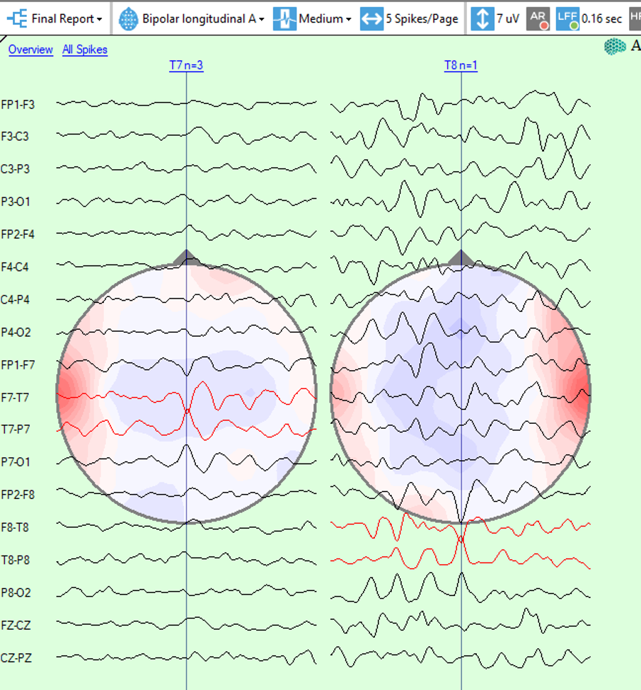 spike analysis