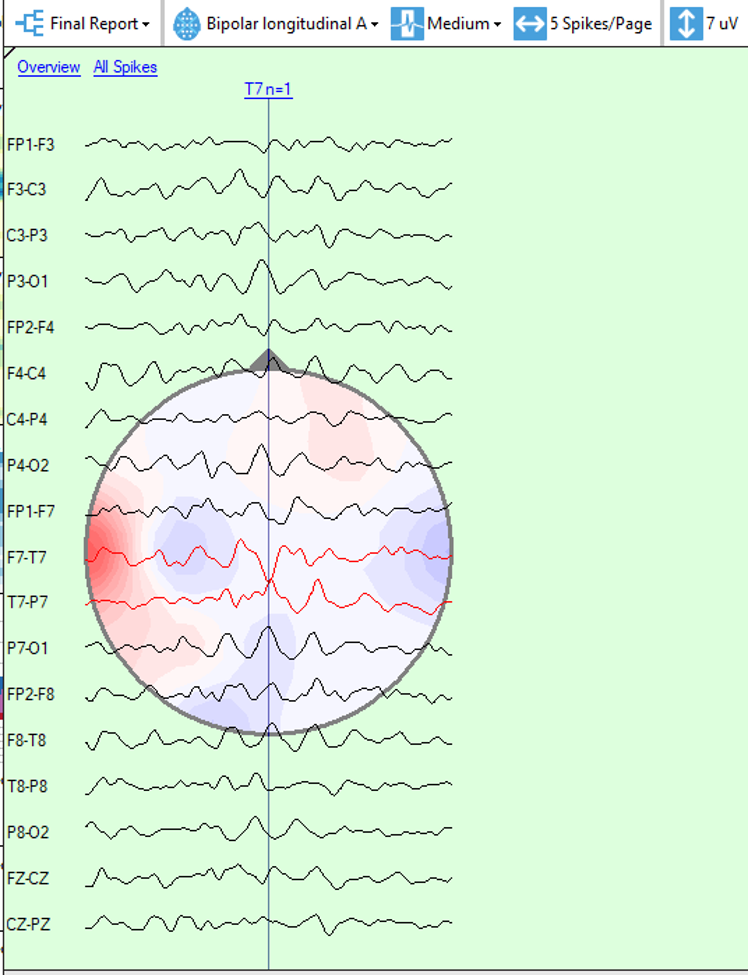 spike analysis