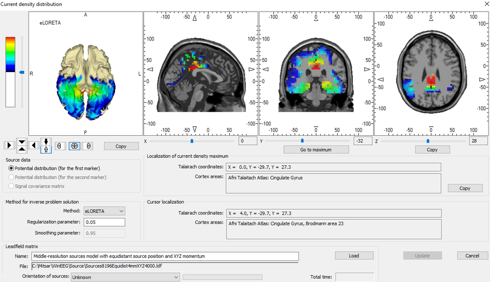 Overlay of brain scans showing current density distribution, with highlighted maximum activity in the cingulate gyrus, based on eLORETA analysis on a sagittal and axial views.