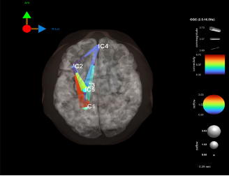 Medical imaging scan showing a 3D color-coded model of a brain with labeled points C2, C3, and C4, used for analyzing brain activity or structures.