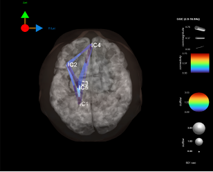 Medical imaging scan showing brain with labeled regions IC2, IC4, IC1