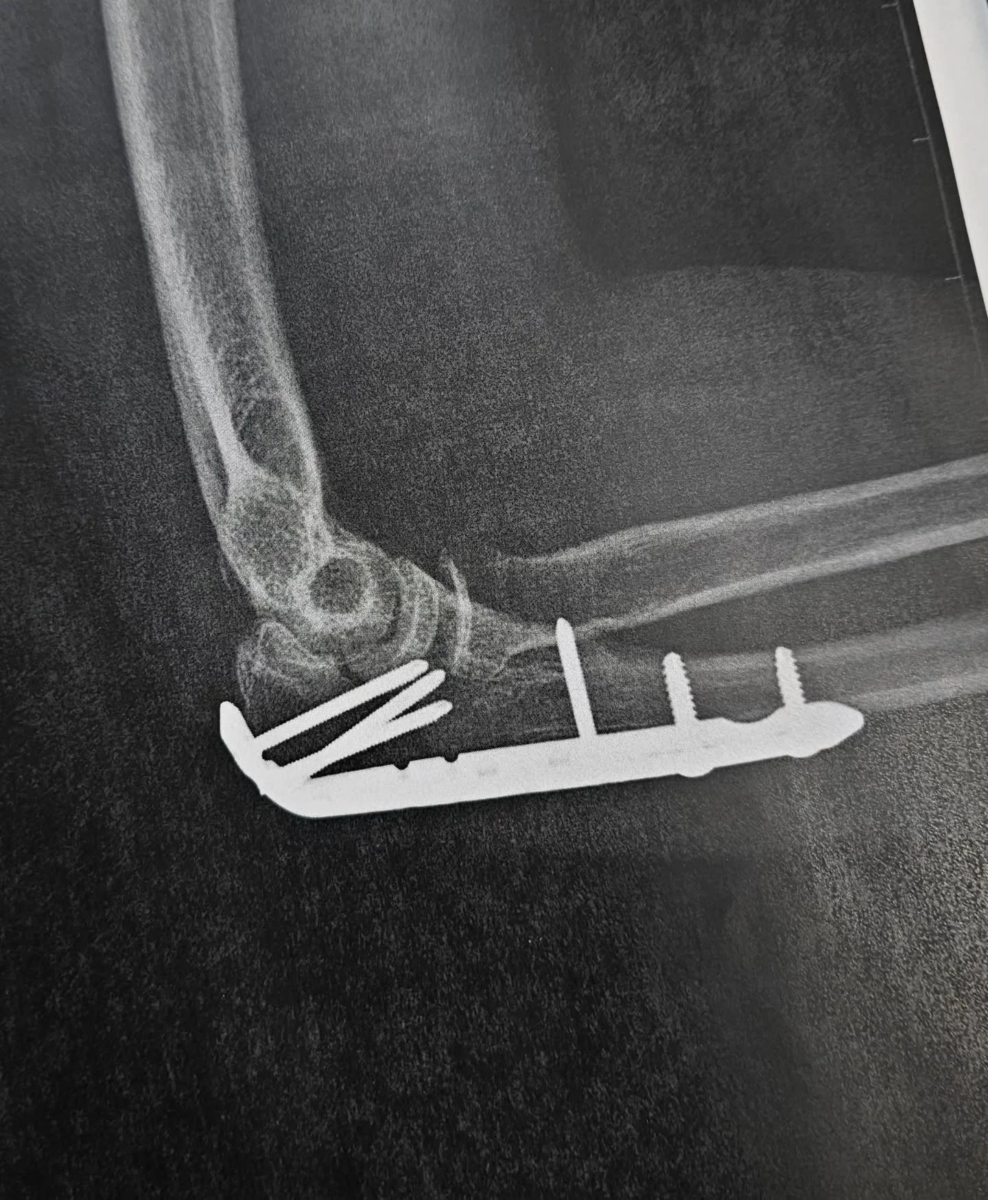 Two weeks post-op and we are so back 🤍
I will be getting everyone rescheduled by the end of the week! Can't wait to see y'all and be a lil yattin shrimp every day again 🦐

#tattooartist #tattooart #tattoos #gothgirl #fracture