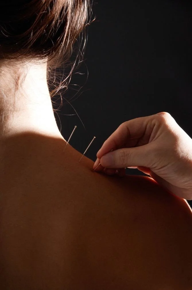 Acupuncture practitioner inserting fine needles into a patient's upper back during a Traditional Chinese Medicine treatment.