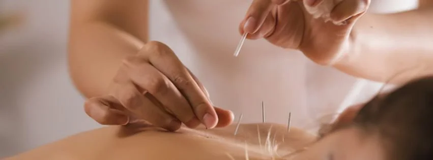 Acupuncture treatment showing a practitioner gently inserting fine needles into a patient’s back during a Traditional Chinese Medicine session.