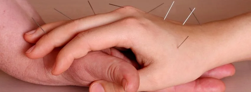 Traditional Chinese Medicine acupuncture treatment with fine needles inserted into a patient's hand and wrist.