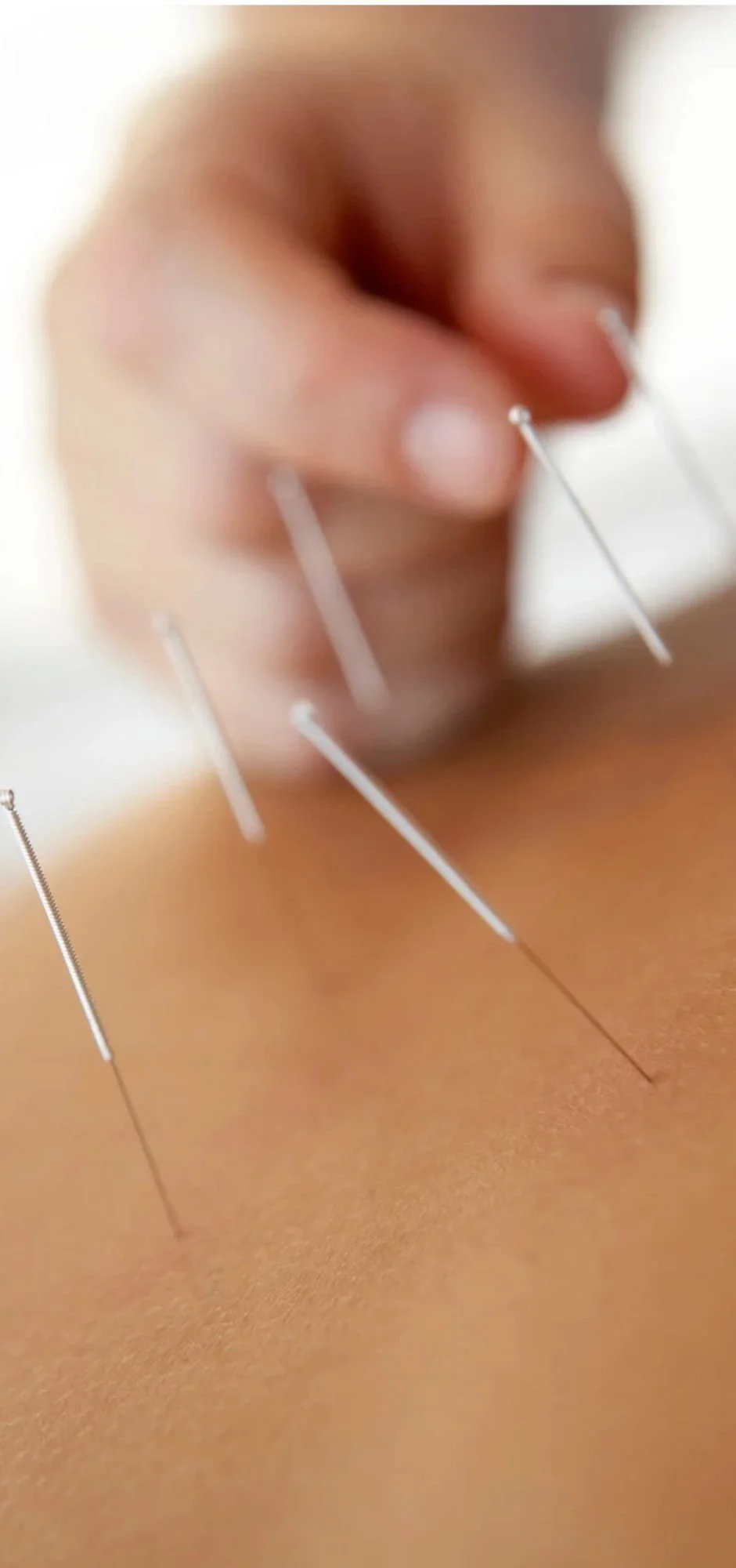 Close-up of fine acupuncture needles inserted into the skin during a Traditional Chinese Medicine treatment.