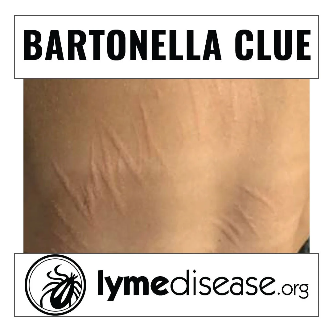The Bartonella clue hidden in plain sight