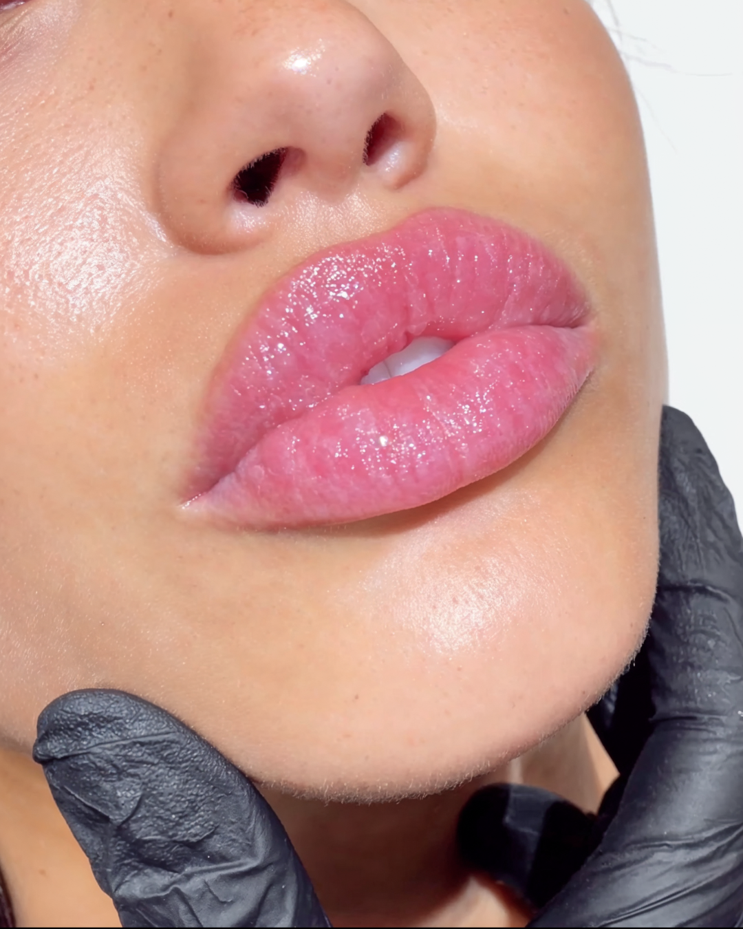 Where Is the Best Lip Filler in Dallas, Texas? Why Clients Choose MNML Med Spa in Richardson