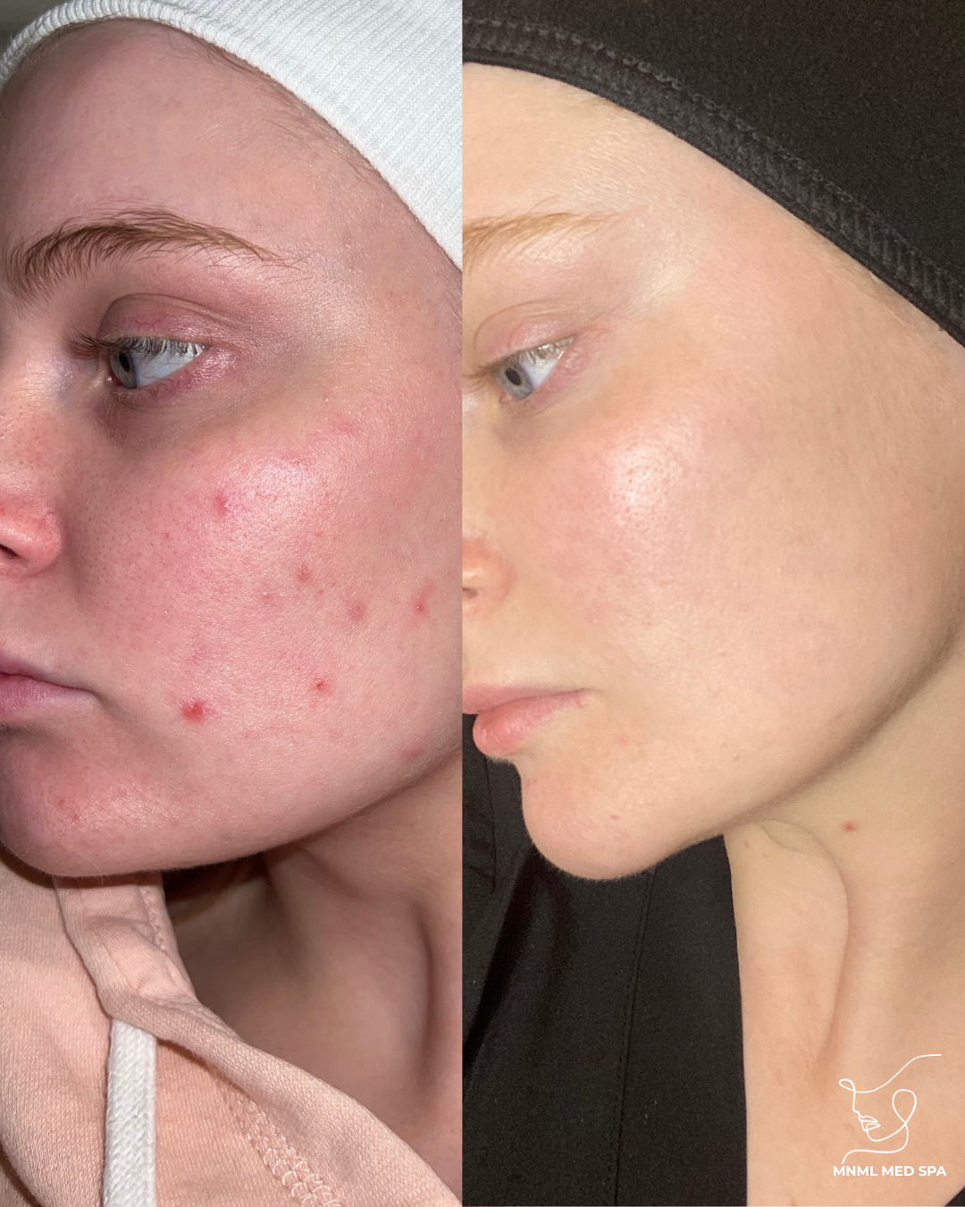Side-by-side comparison of a woman's face showing before and after skin treatment; the left side displays redness and acne, while the right side shows clear, smooth skin.