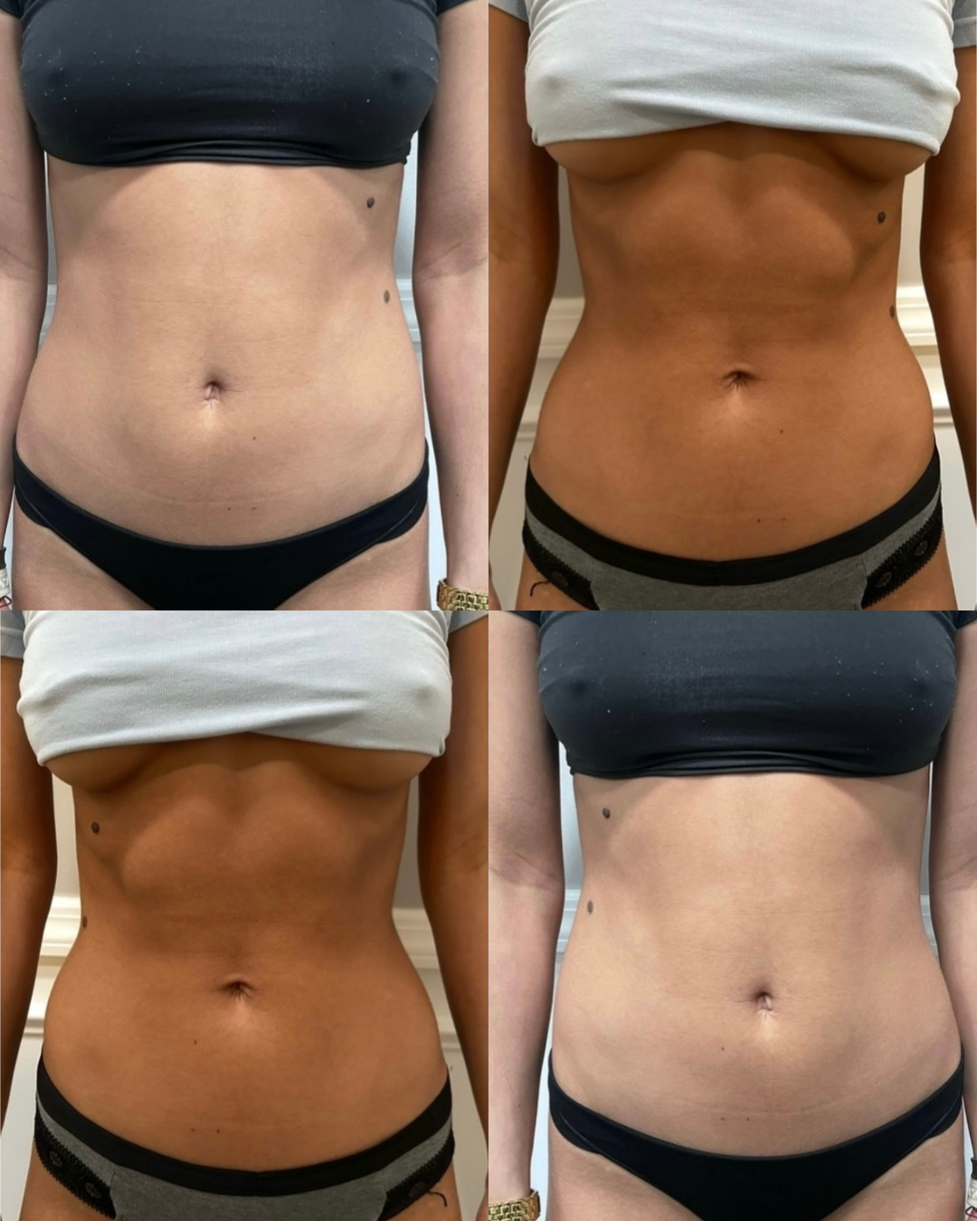 Comparison of a woman's midsection before and after a fitness transformation, showing reduced abdominal fat and toned stomach.