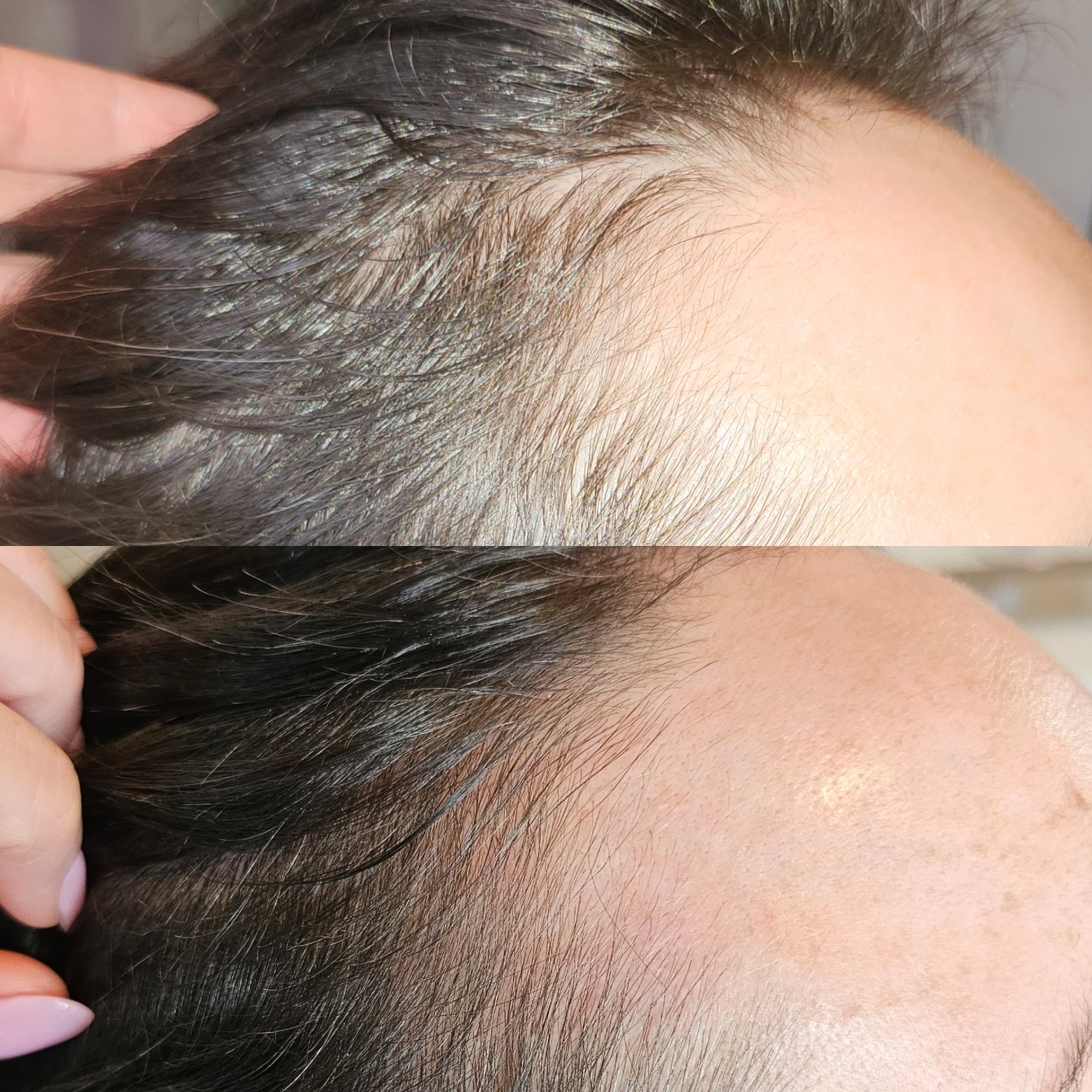Close-up of a person's scalp showing before and after hair growth or hair treatment, with thicker, fuller hair in the bottom image.
