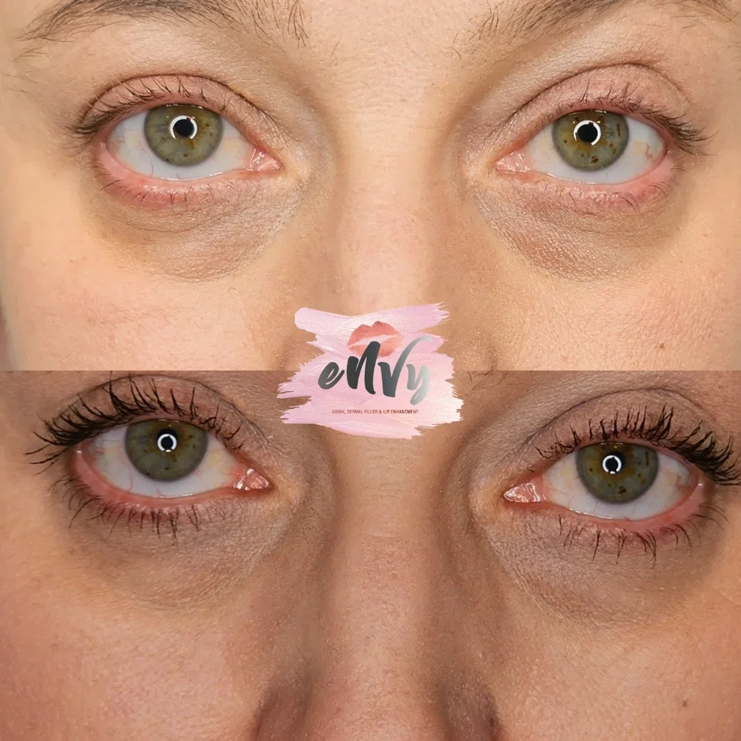 Close-up of a woman's eyes showing before and after cosmetic enhancement, with an 'eNvy' logo in the center.