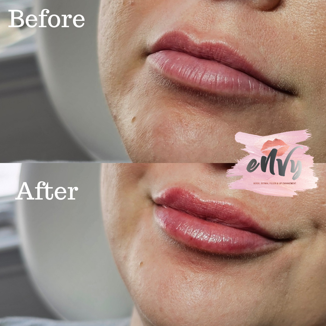 Close-up of lips before and after lip enhancement treatment, showing fuller, glossier lips in the after image.