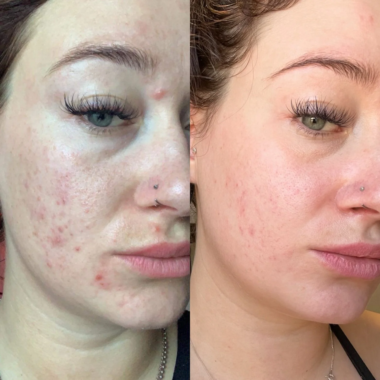 Side-by-side comparison of two women showing skin improvement; the woman on the left has redness and acne scars, the woman on the right has clearer skin.