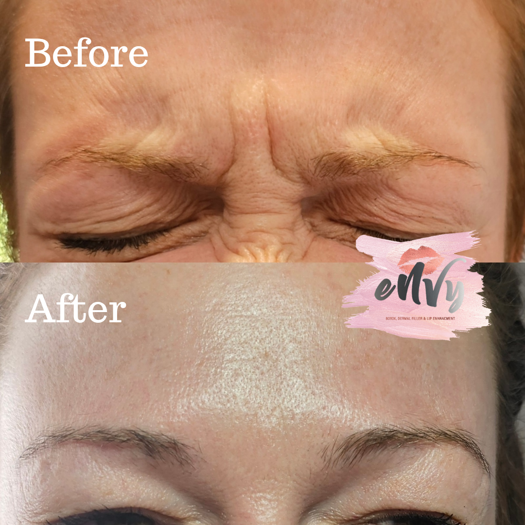 Close-up of a person's forehead before and after cosmetic treatment, showing reduction in wrinkles and smooth skin.