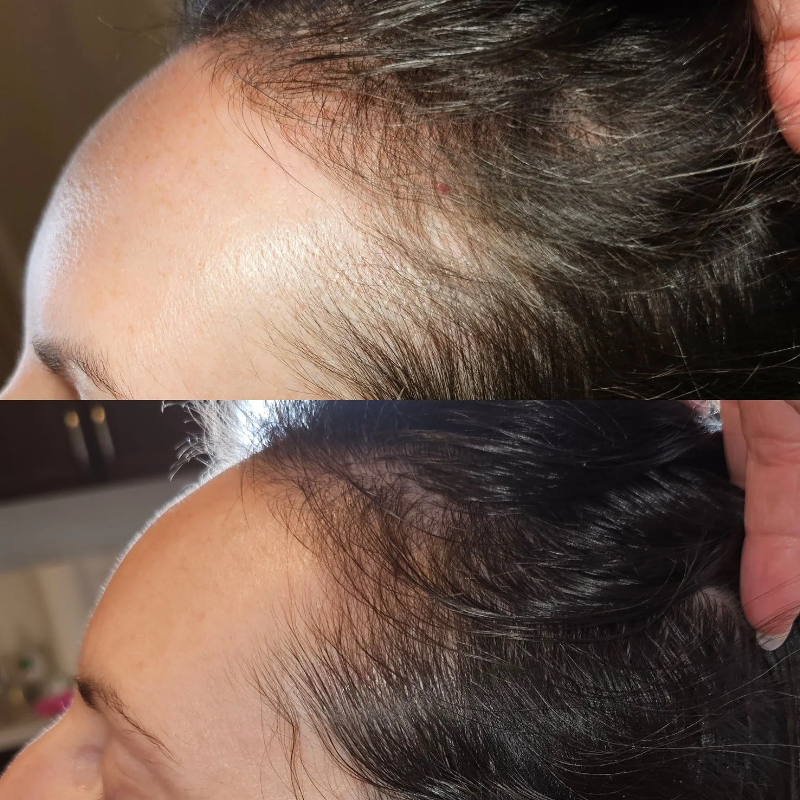 Comparison of a person's scalp before and after hair treatment showing improved hair density and coverage.