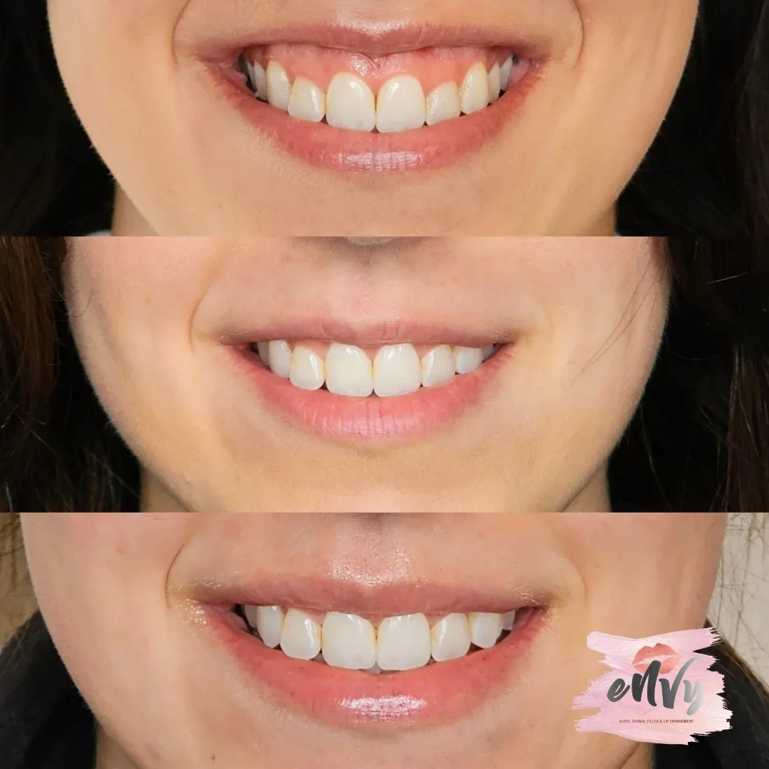 A triptych of close-up images of a person's smiling mouth showing changes in the teeth before, during, and after dental treatment, with a logo in the bottom right corner.