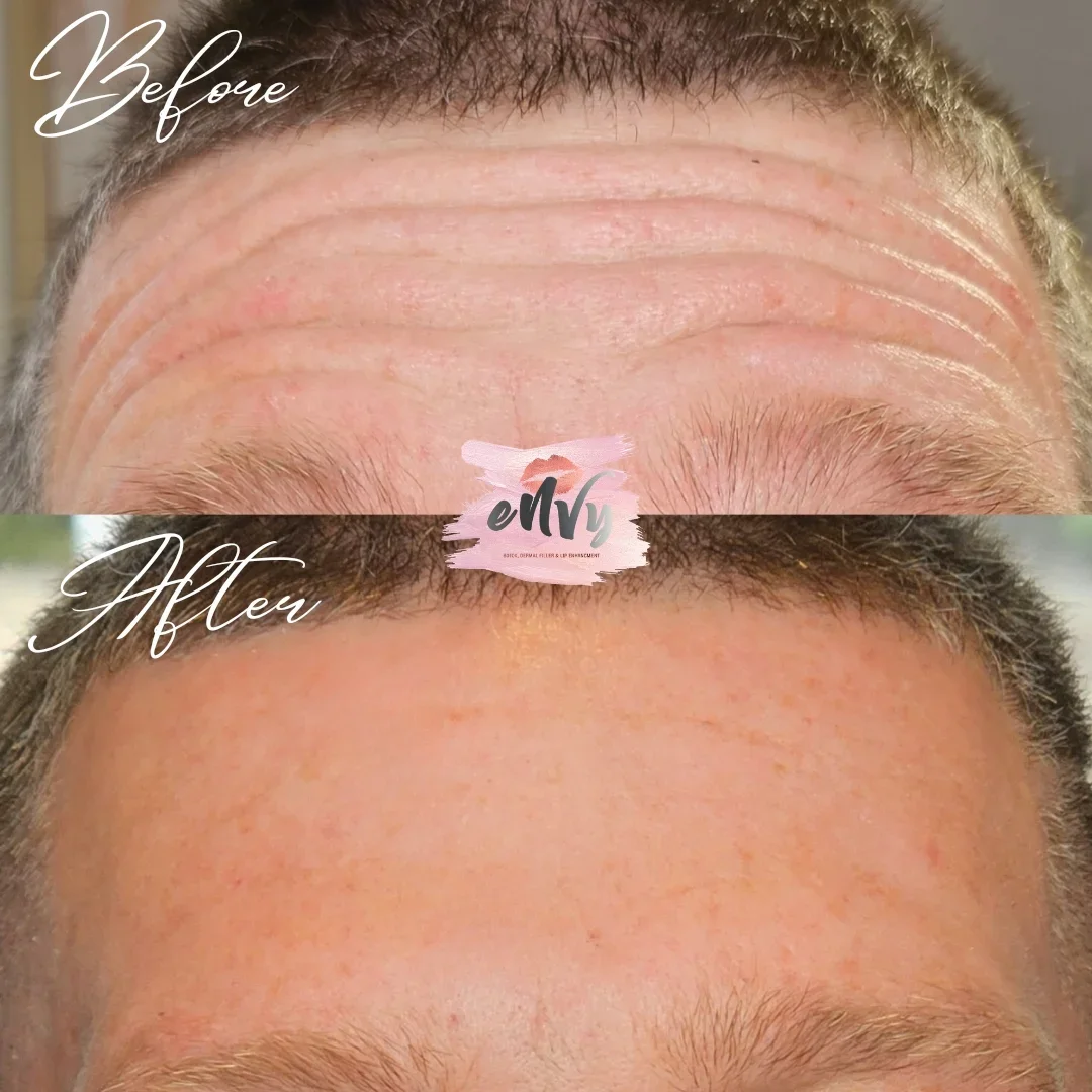 Comparison of forehead before and after skin treatment showing reduced wrinkles and smoother skin.