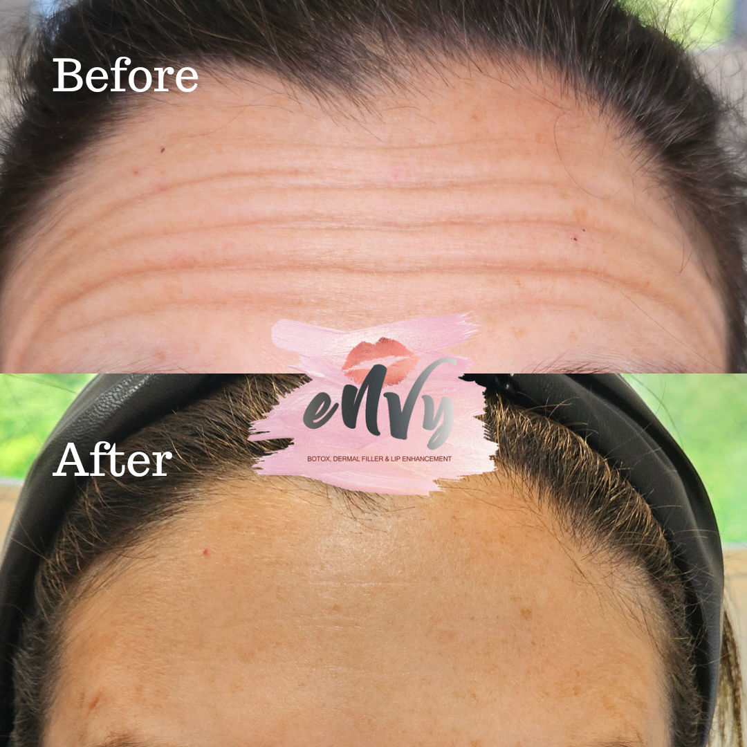 Comparison of a forehead before and after cosmetic treatment, showing reduced wrinkles and a smoother skin surface.