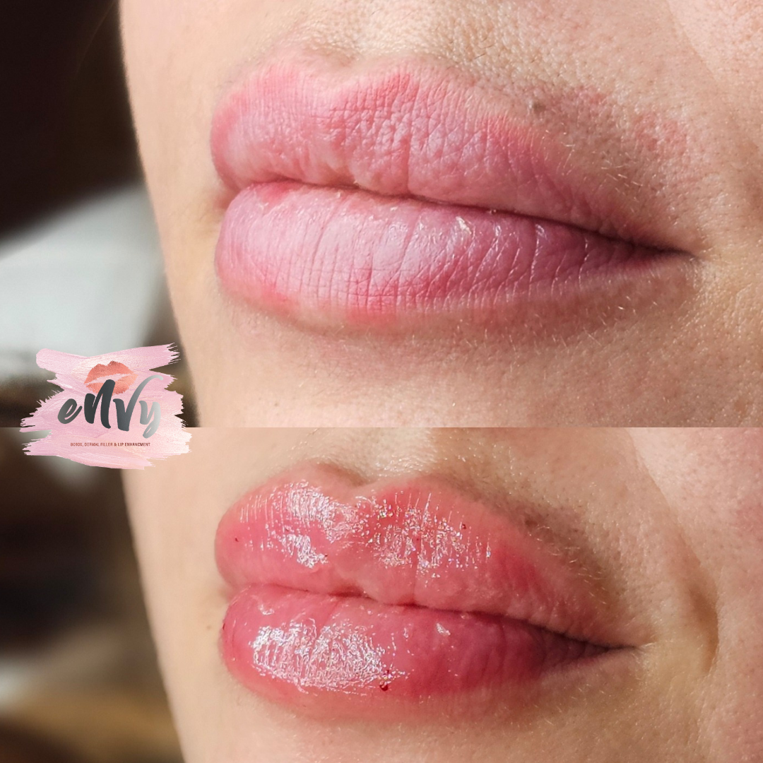 Close-up of lips showing before and after lip enhancement, with the bottom image featuring glossy, fuller lips.