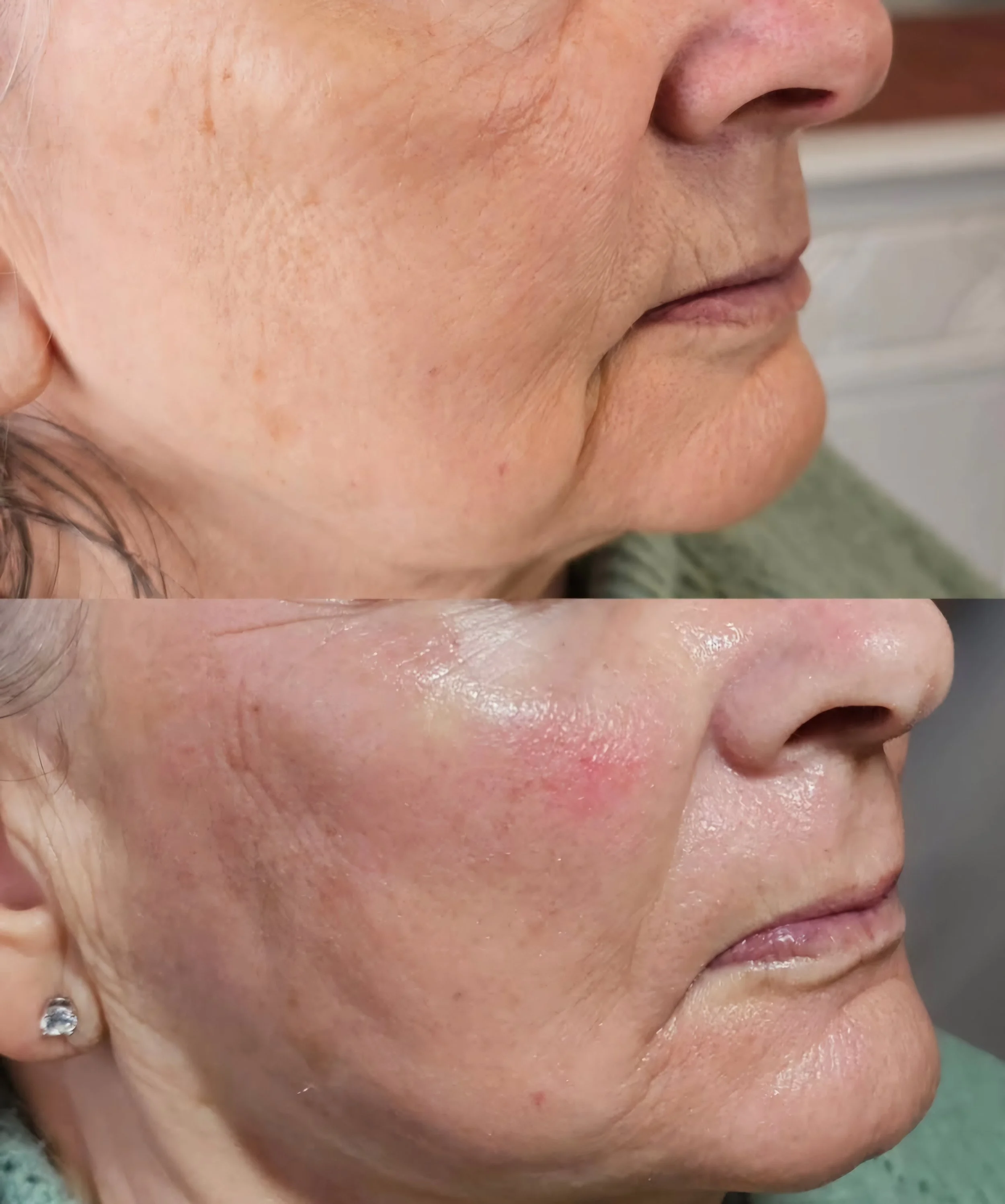 Side-by-side comparison of a woman’s cheek before and after skincare treatment, showing improved skin texture and reduced redness.