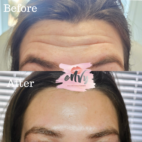Comparison of forehead skin before and after cosmetic treatment, showing reduction of wrinkles and smoother skin.