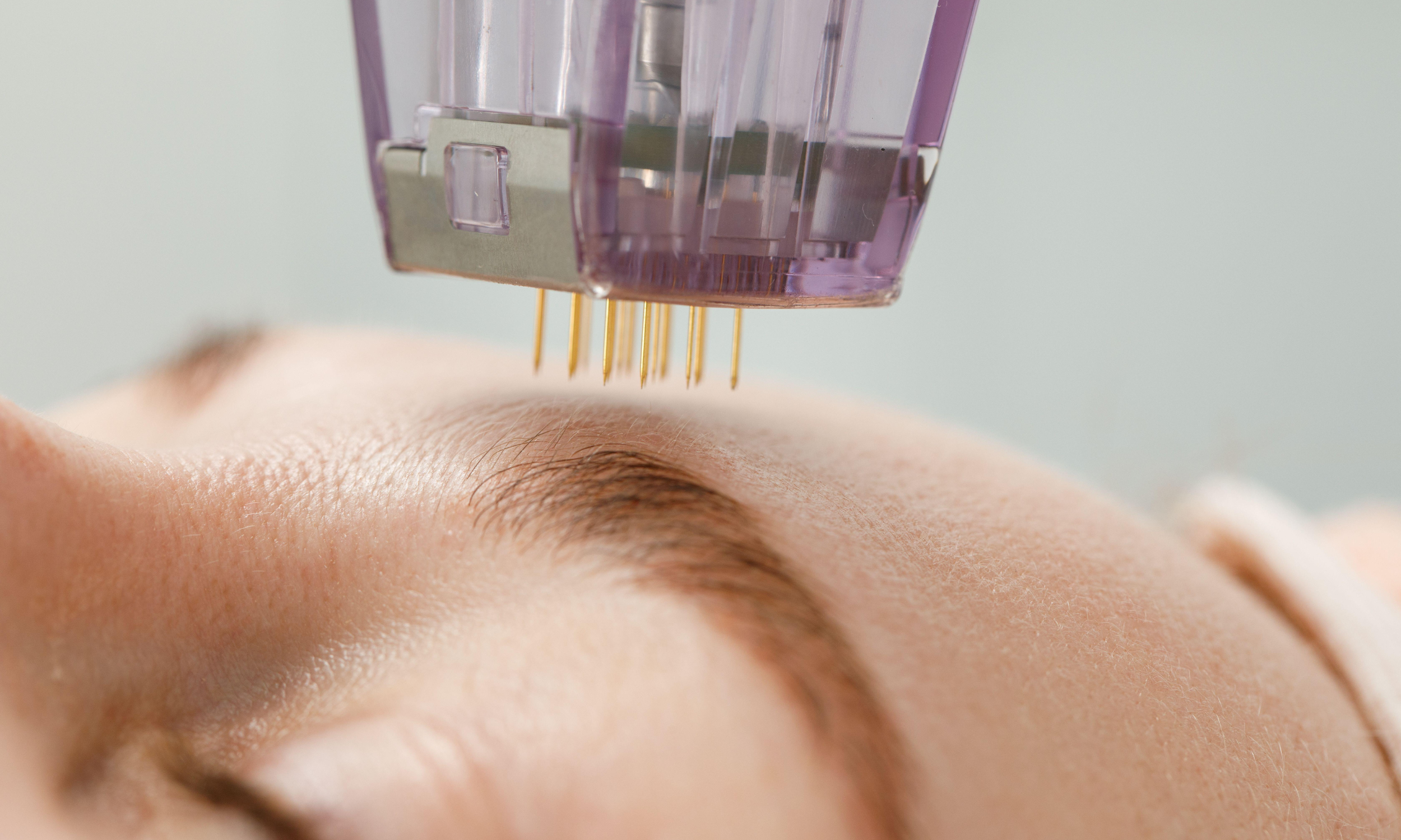 How Many Microneedling Sessions for Results in Fort Mill?