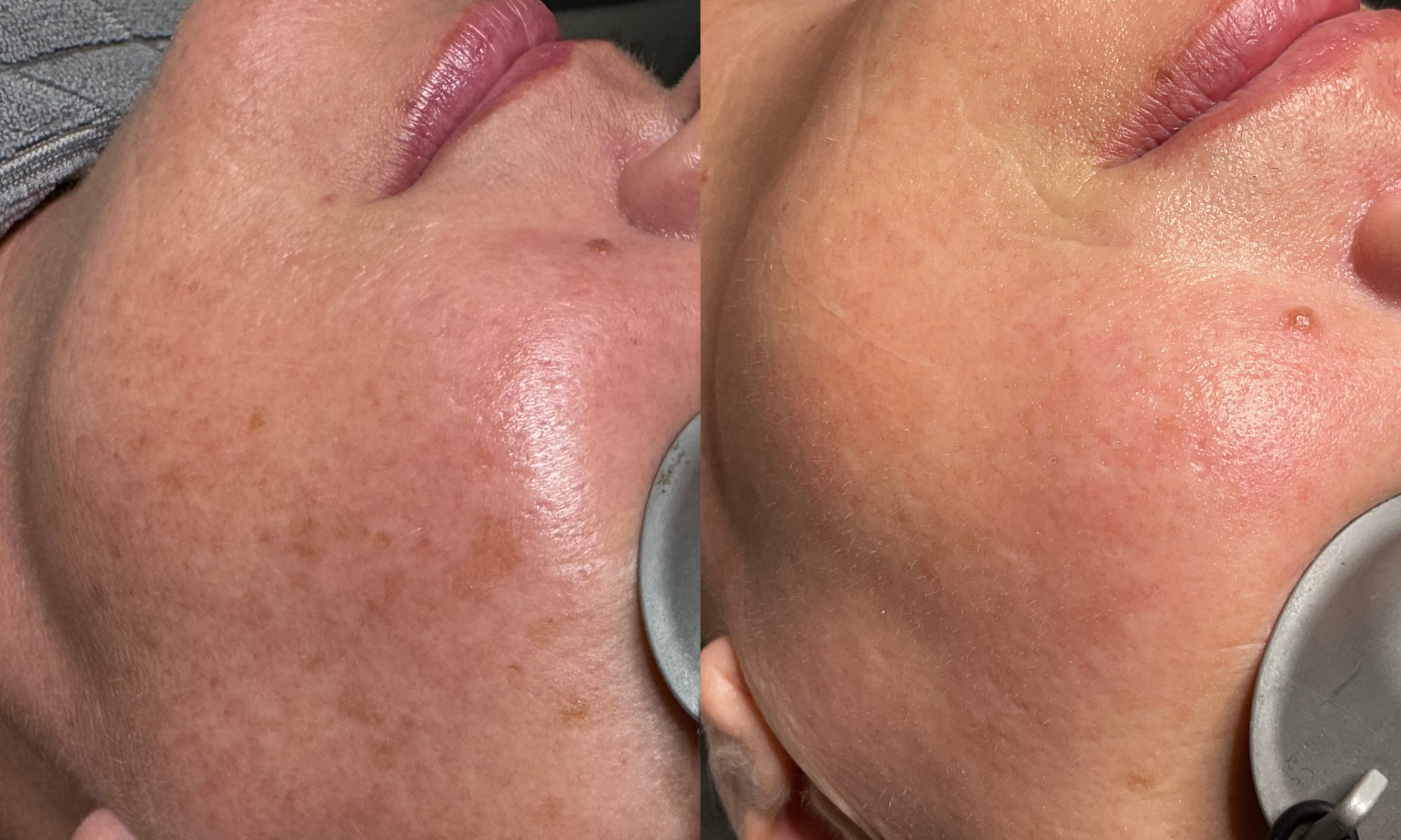 IPL PhotoFacial in Fort Mill, SC: What It Treats, What to Expect, and Why Fall Is a Great Time to Start