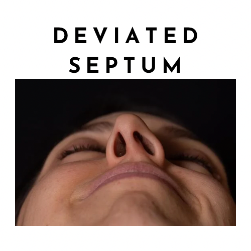 How do I fix a deviated septum?