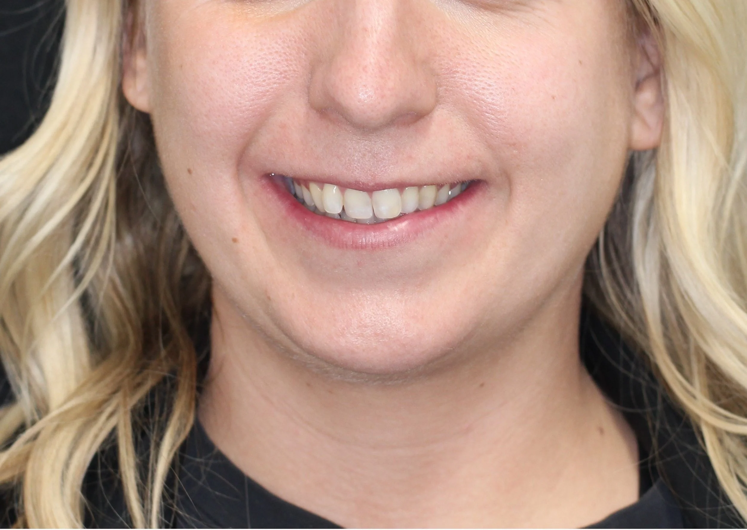 Limited jaw support with dental compensation