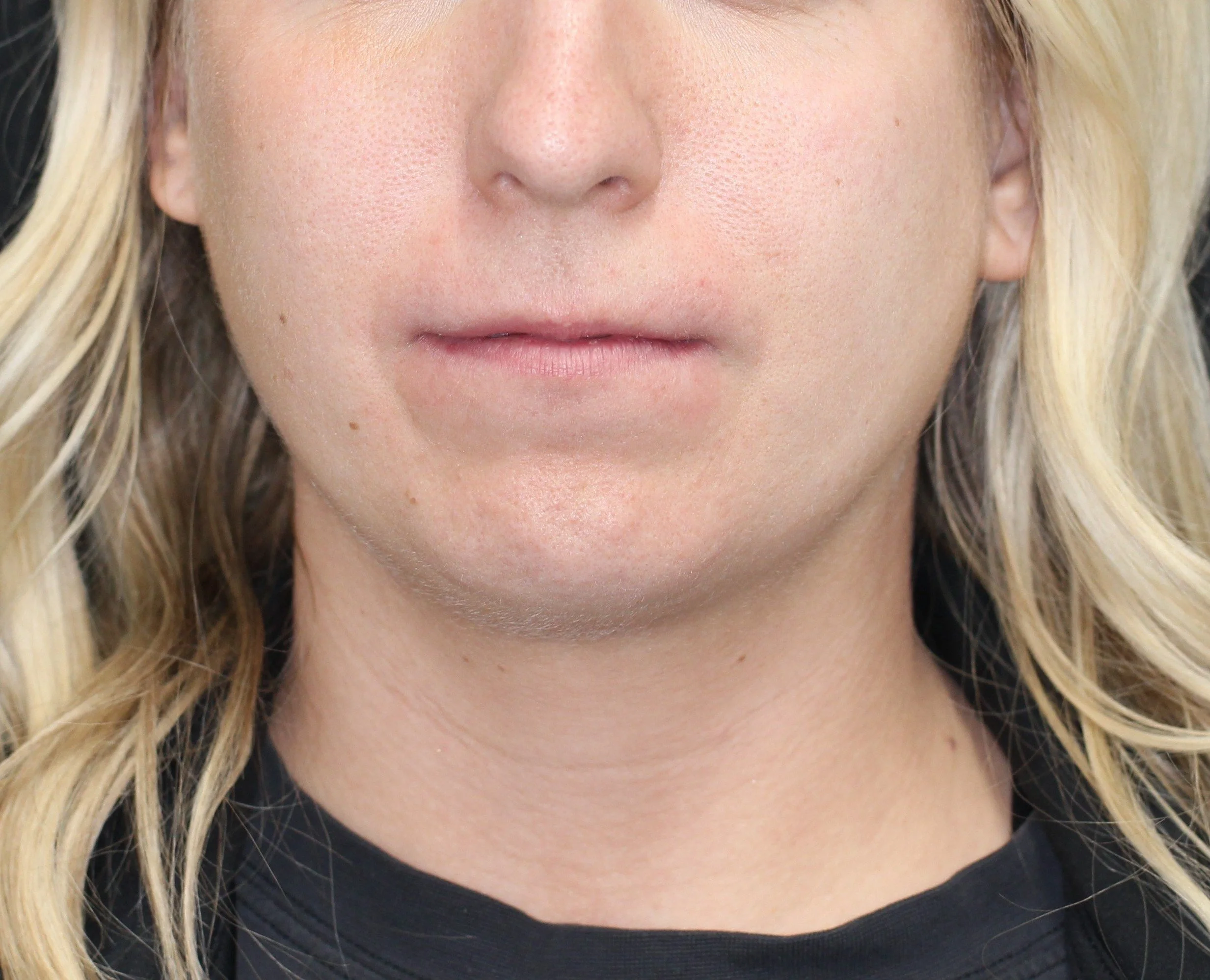 Underdeveloped jaw structure affecting facial balance