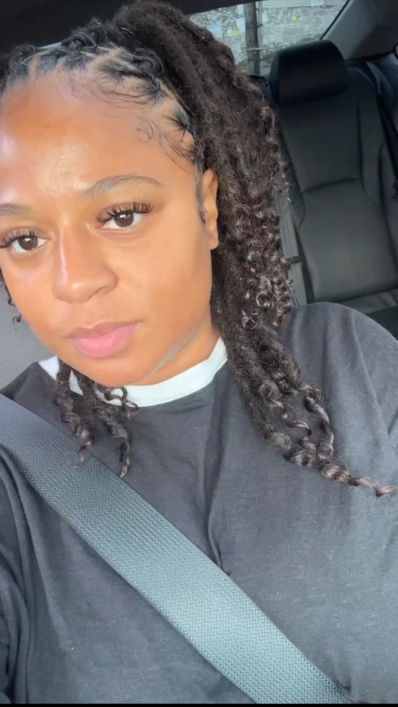 How I Finally Got My Hormonal Acne Under Control ✨