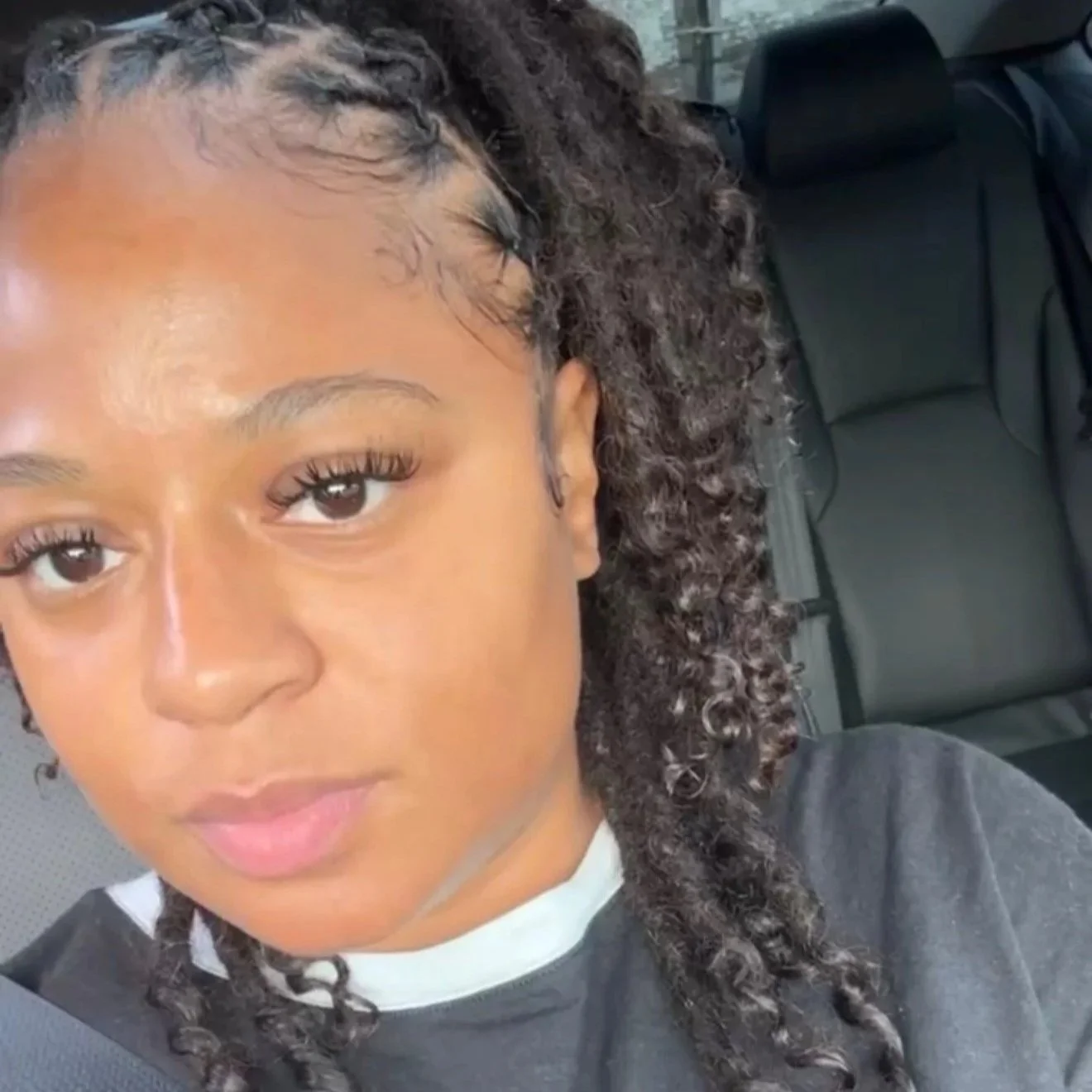 How I Finally Got My Hormonal Acne Under Control ✨