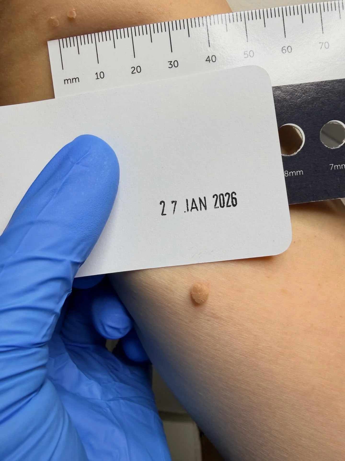 The little thing that keeps catching on your clothes&hellip; 🤍

You know the one.
It&rsquo;s small. You&rsquo;ve ignored it for months.
But it snags. It rubs. It annoys you every single day.

At PODIVA, CryoPen allows us to treat common benign lesio