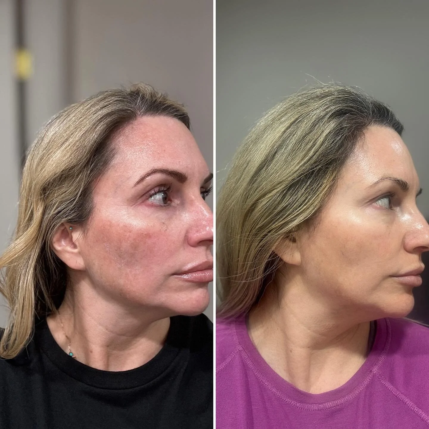 Hi! 🤗 If you know me, you know my skin and hair are my constant Work. In. Progress. 🫠 I took this pic to track my hair progress which you Can FINALLY see!🎉 &hellip;but peep my skin!Notice the changes? 👀
Improved skin texture, tone, AND new hair g