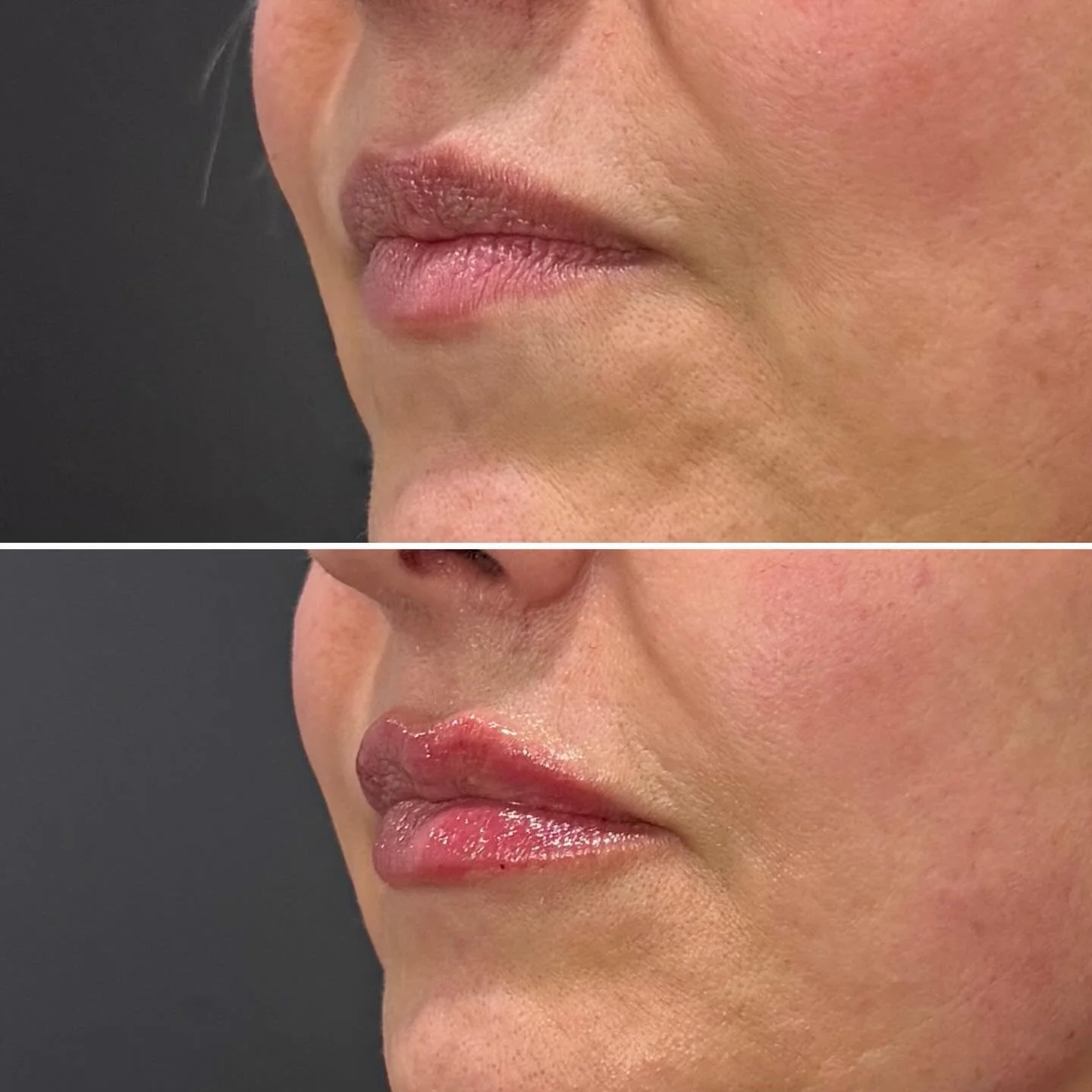 This Holiday lip refresh is GOLD💫

&bull;Desert Sun Aesthetics&bull;
Tox &bull; Fillers &bull; Biorevitalization 
👩🏻Sophia || MBA, RN, CLT
📍312 N. Alma School Rd, Su#2, Chandler 85224, Inside Brow Bliss 
📱(623)400-3813
💻www.desertsunaesthetics.