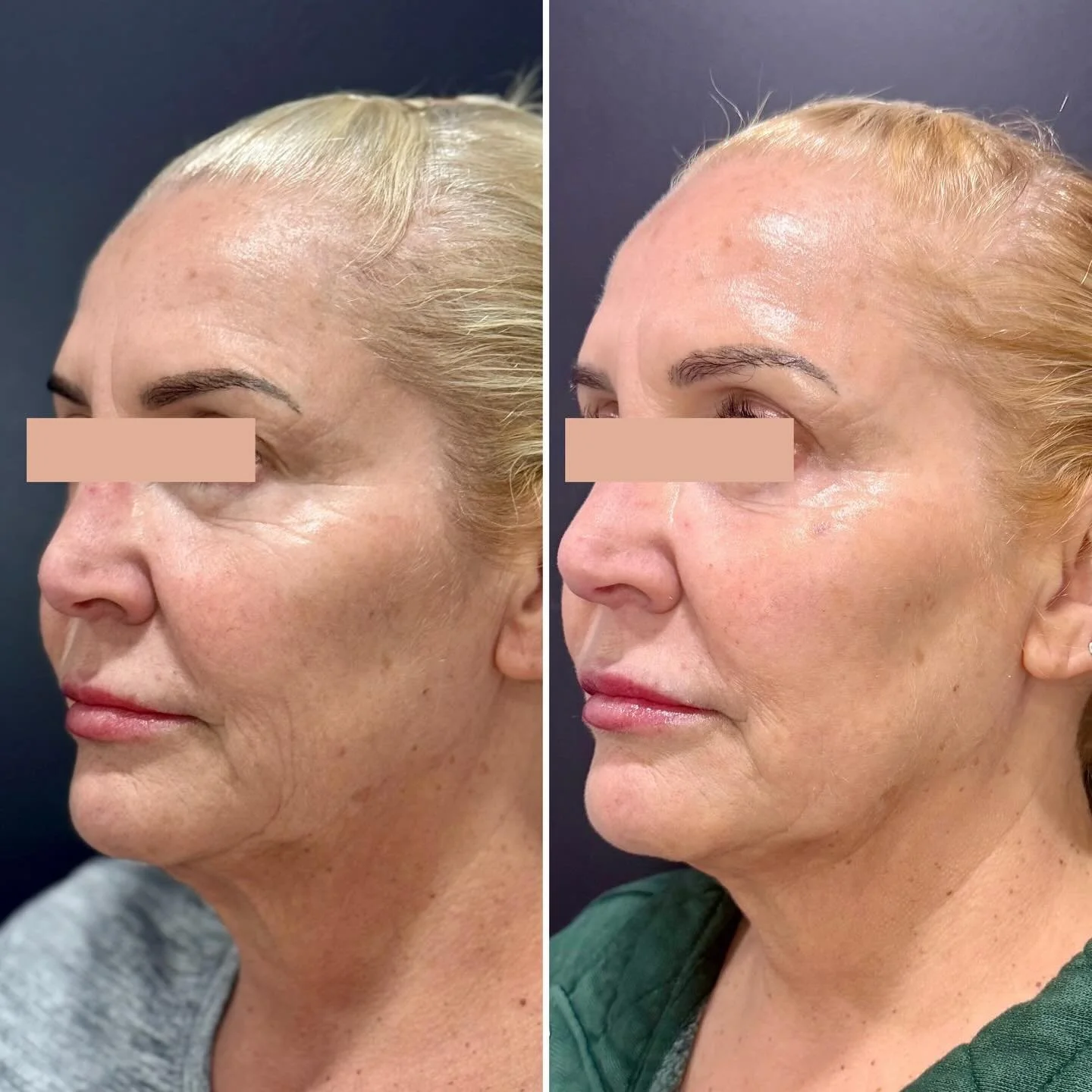Just over here admiring this Glow Up🤗 I mean&hellip;come on!  Can we just talk about the under eyes alone??? Hellooo!! 🤩 Shoot me a DM if you want to know her whole regimen, happy to share and I&rsquo;ll post more eventually &hellip;but for now, le