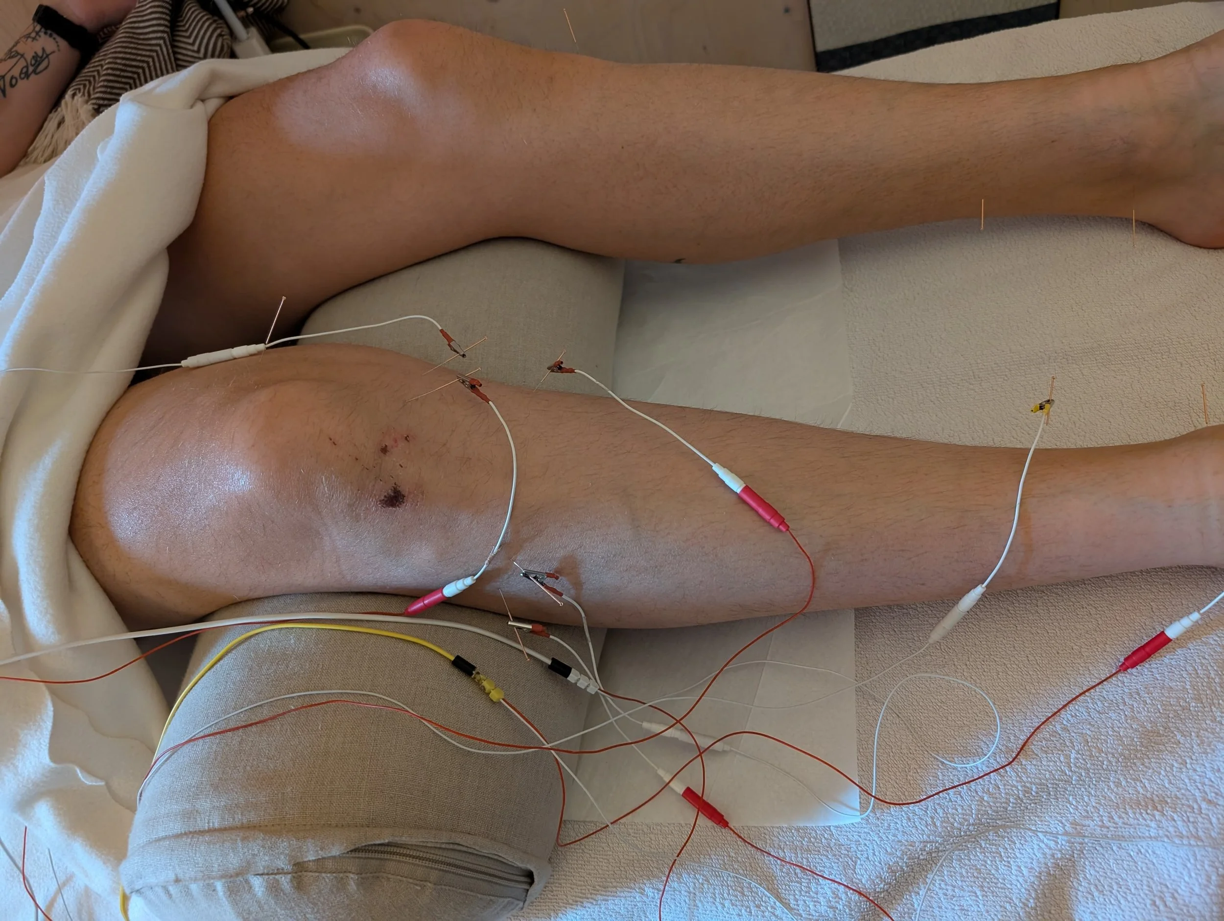 When to Stop: What Injury Really Teaches You About Training