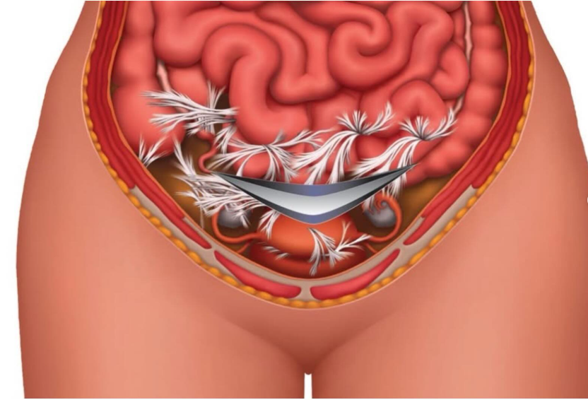 Scar tissue and organs