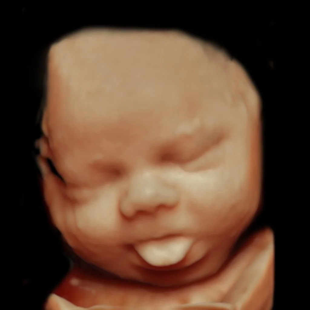 3D ultrasound image of a baby's face with closed eyes and tongue sticking out.