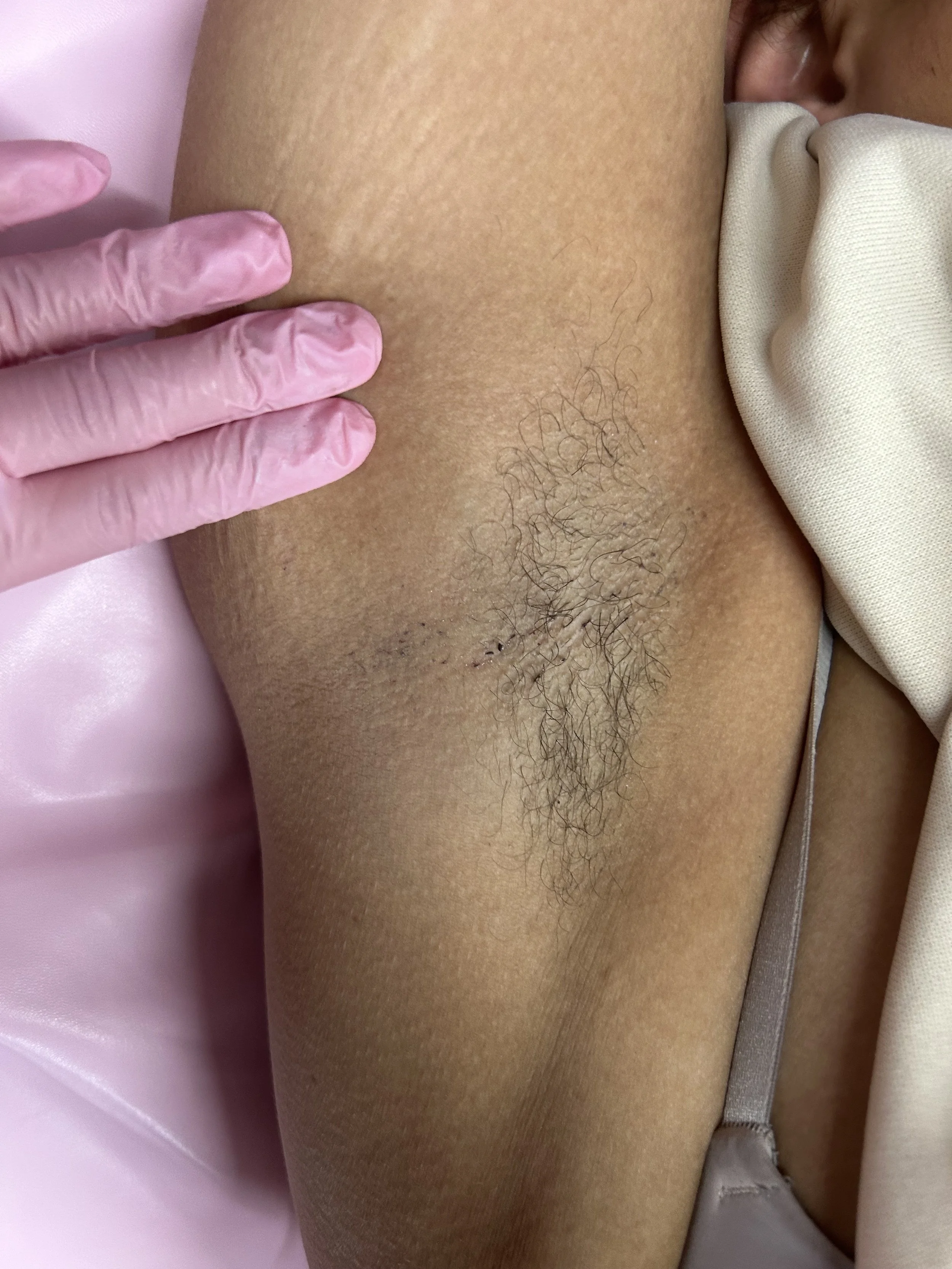 before underarm wax, hair removal , hair , waxing , arm pit wax, gloves ,esthetician near me ,Doylestown pa , bucks county pa , philly , Philadelphia , pink bed , body waxing , hairs , hairy , self care, get smooth skin today, beauty bae waxing brows