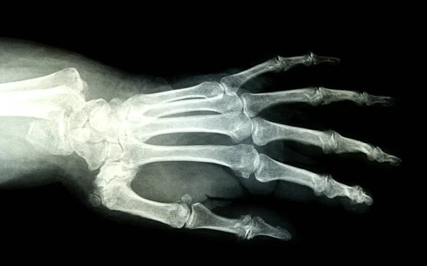 radiografia de una fractura de muñeca