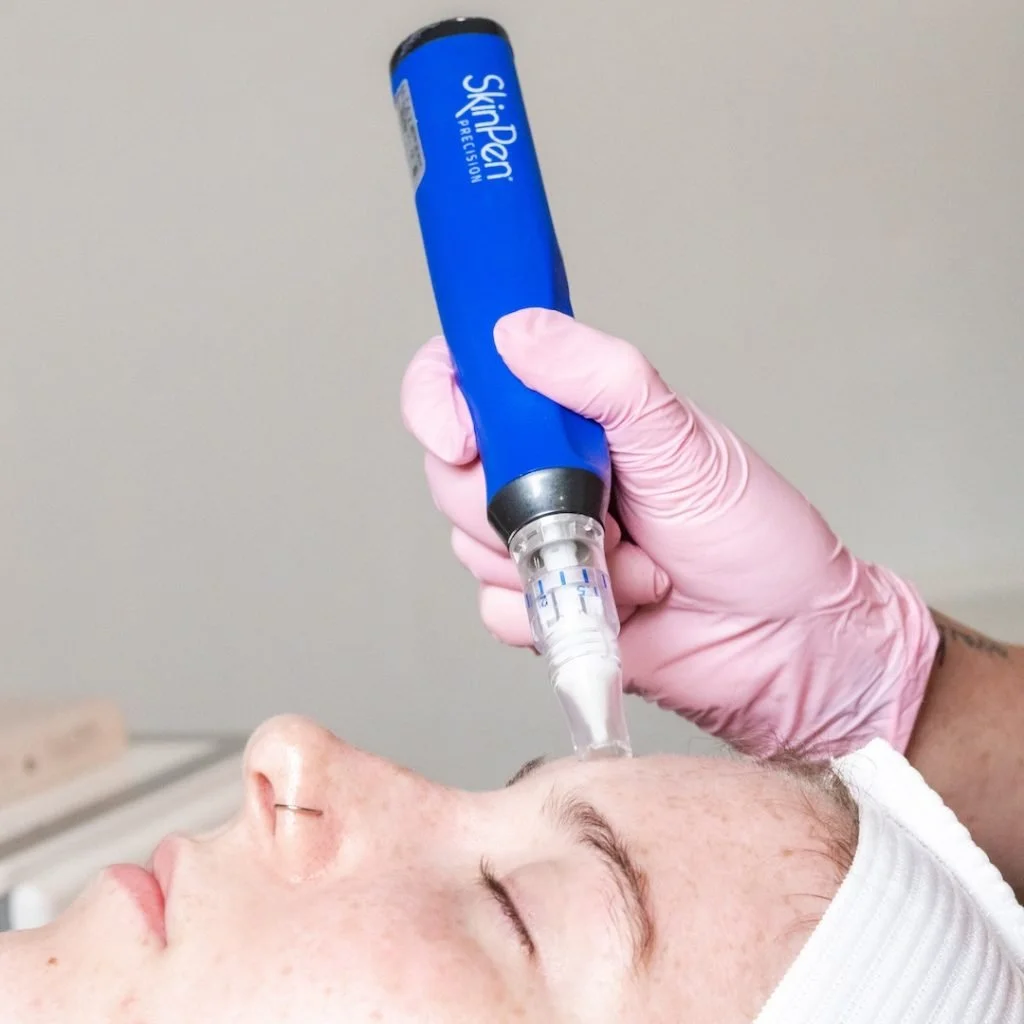 Microneedling: collagen-stimulating skin renewal 