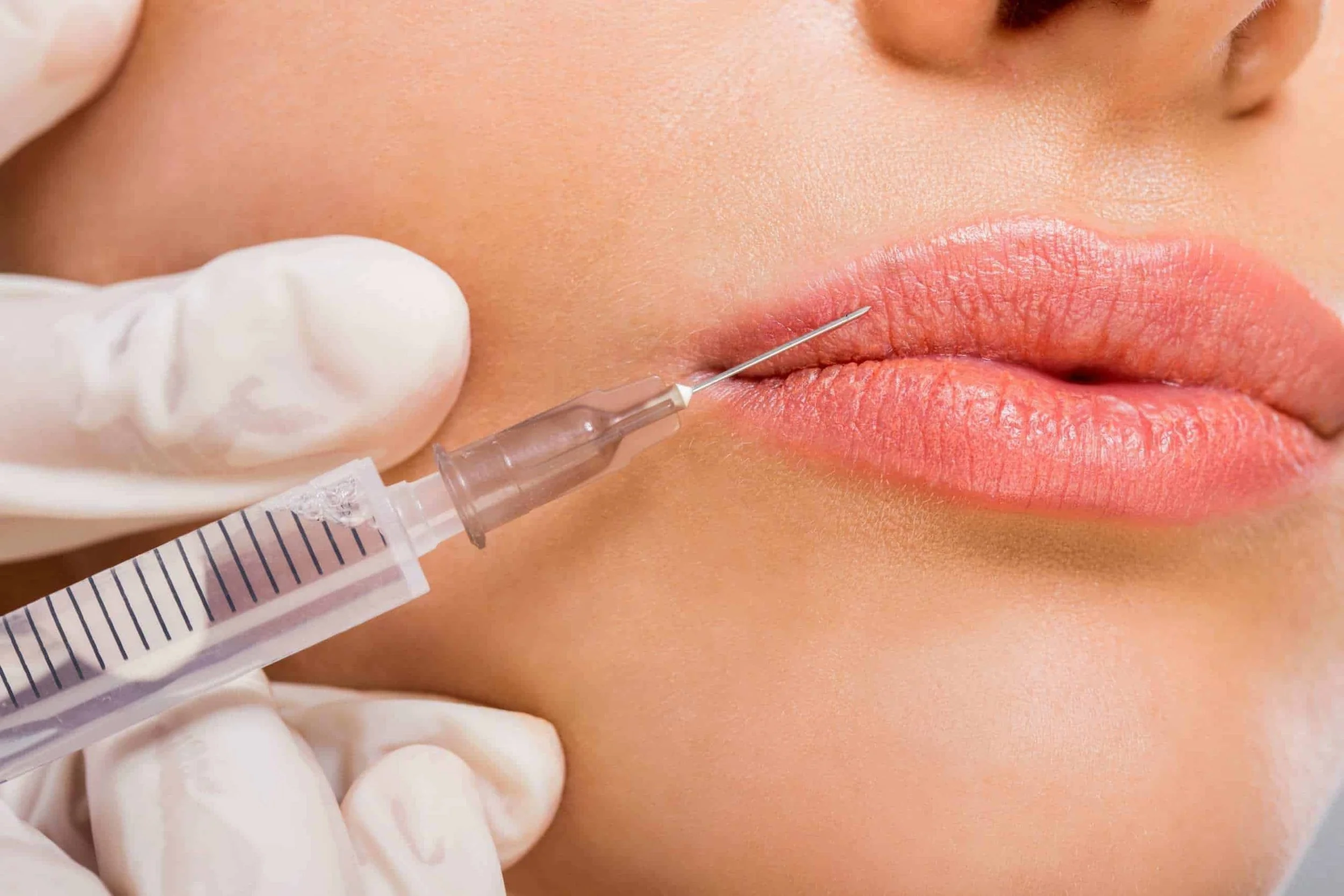 Lip Filler Education: Achieving Soft, Natural &amp; Balanced Lips