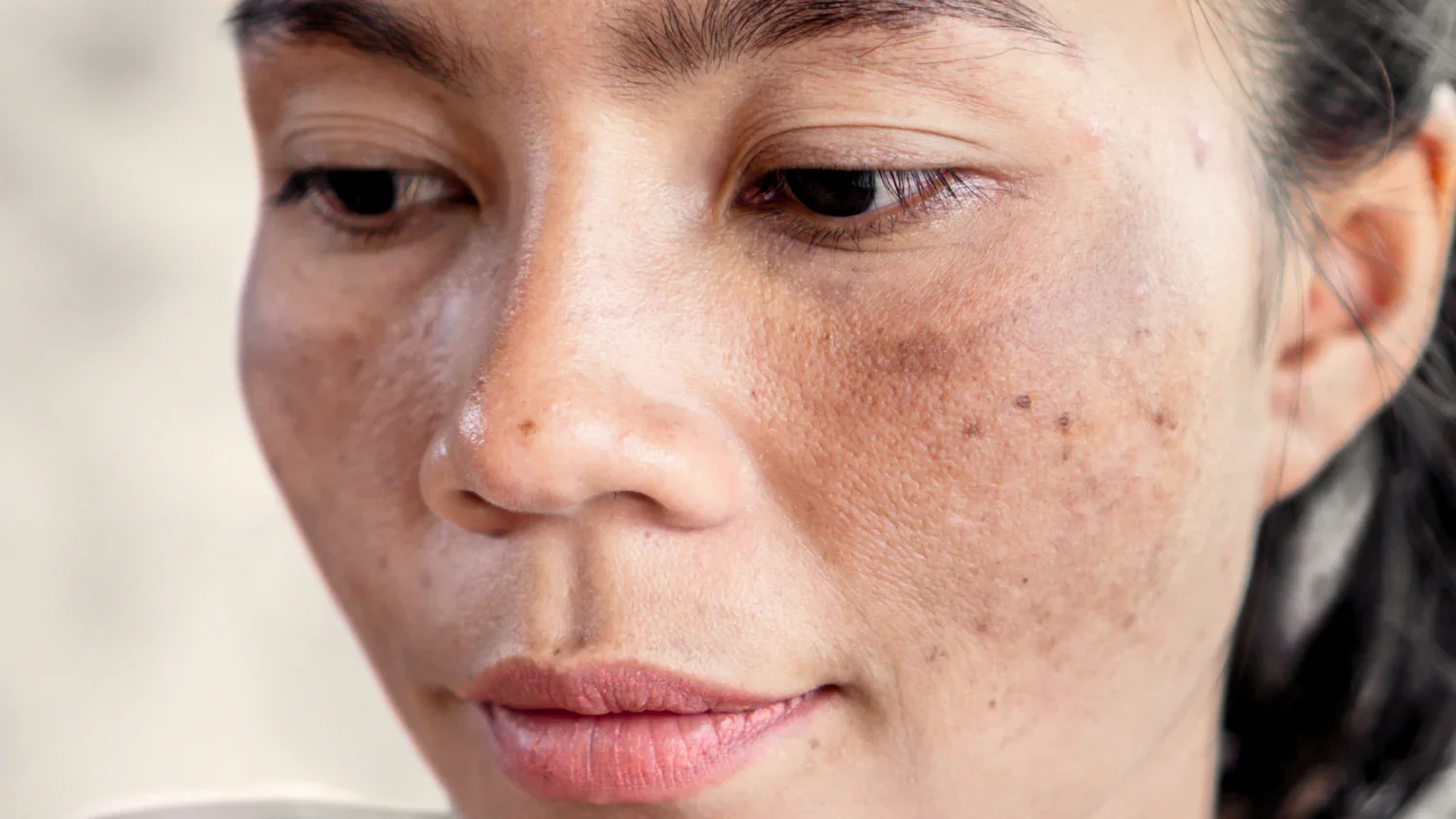Hyperpigmentation: Why Dark Spots Appear on the Skin