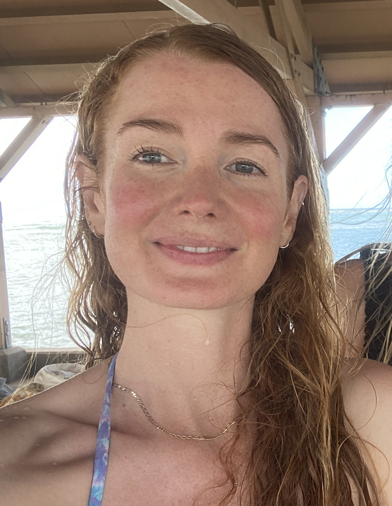 Rosacea_web.png