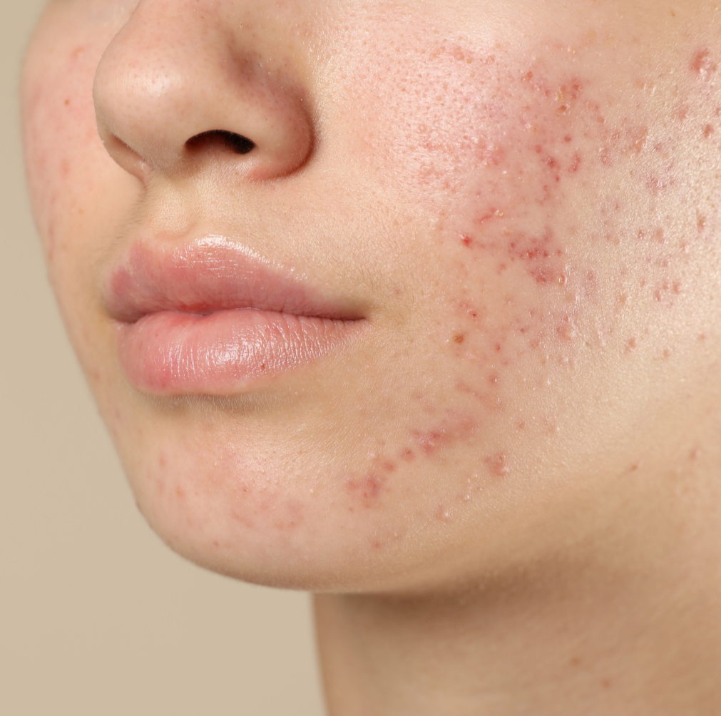 Close-up of a person's face showing acne scars and redness on the cheek near the nose and lips.
