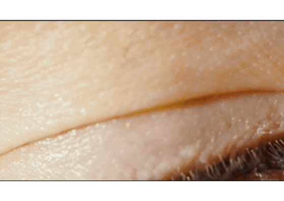 Parkinson´s Disease